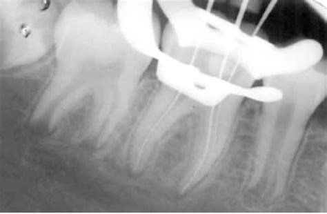patenesia|patencia apical endodontia.